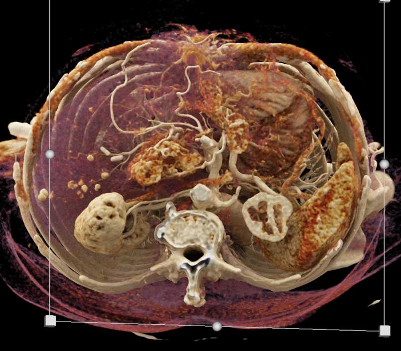 Pancreas Adenocarcinoma - CTisus CT Scan