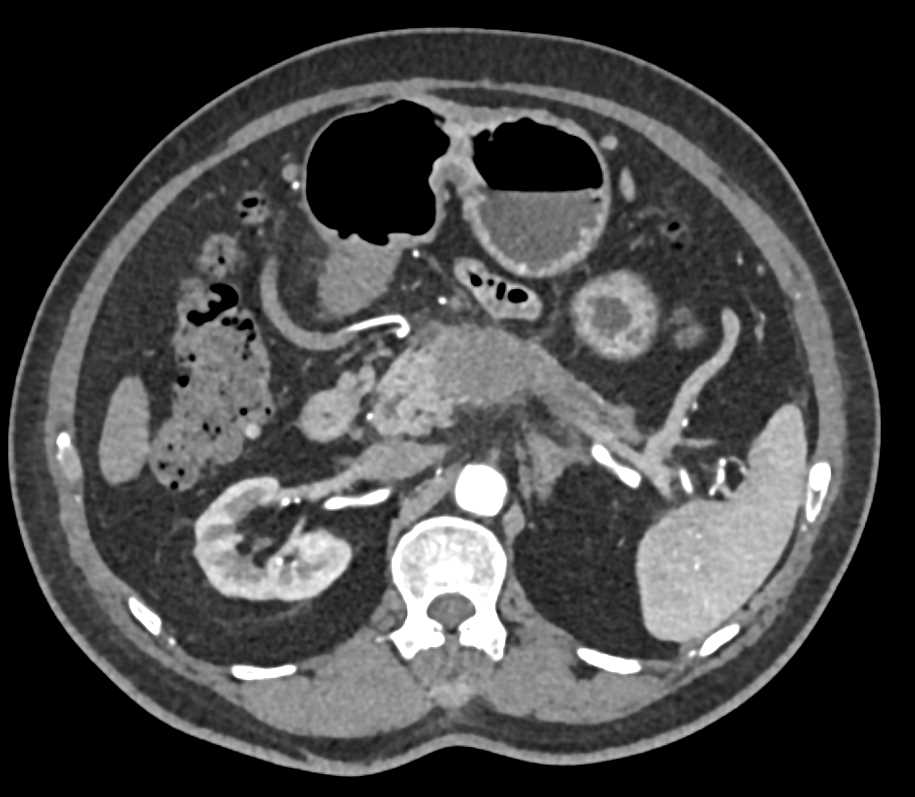 Pancreas Adenocarcinoma - CTisus CT Scan