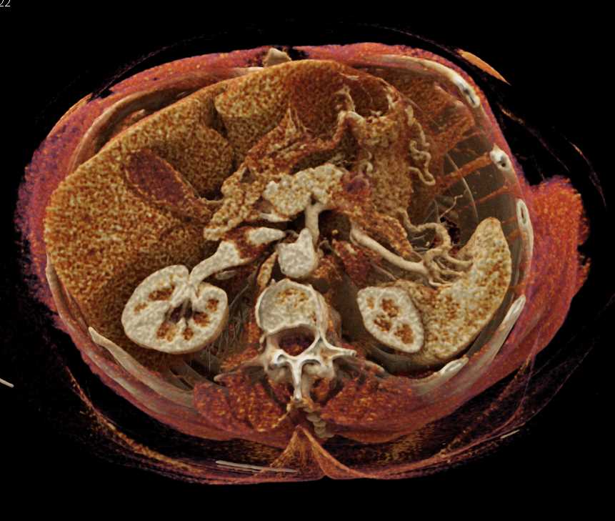 Pancreas Adenocarcinoma - CTisus CT Scan