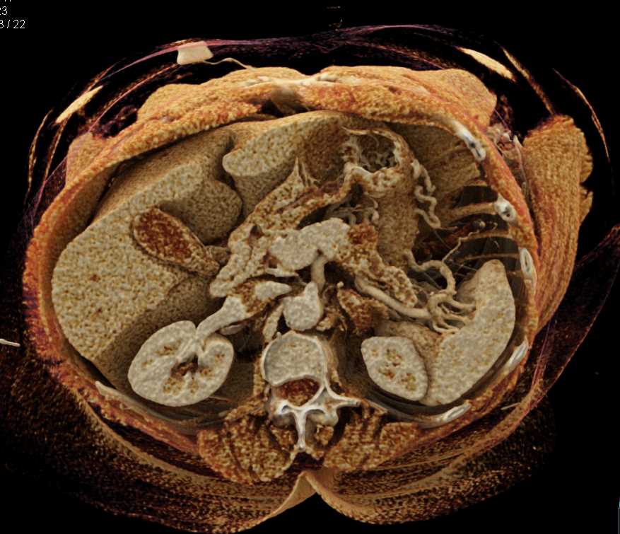 Pancreas Adenocarcinoma - CTisus CT Scan