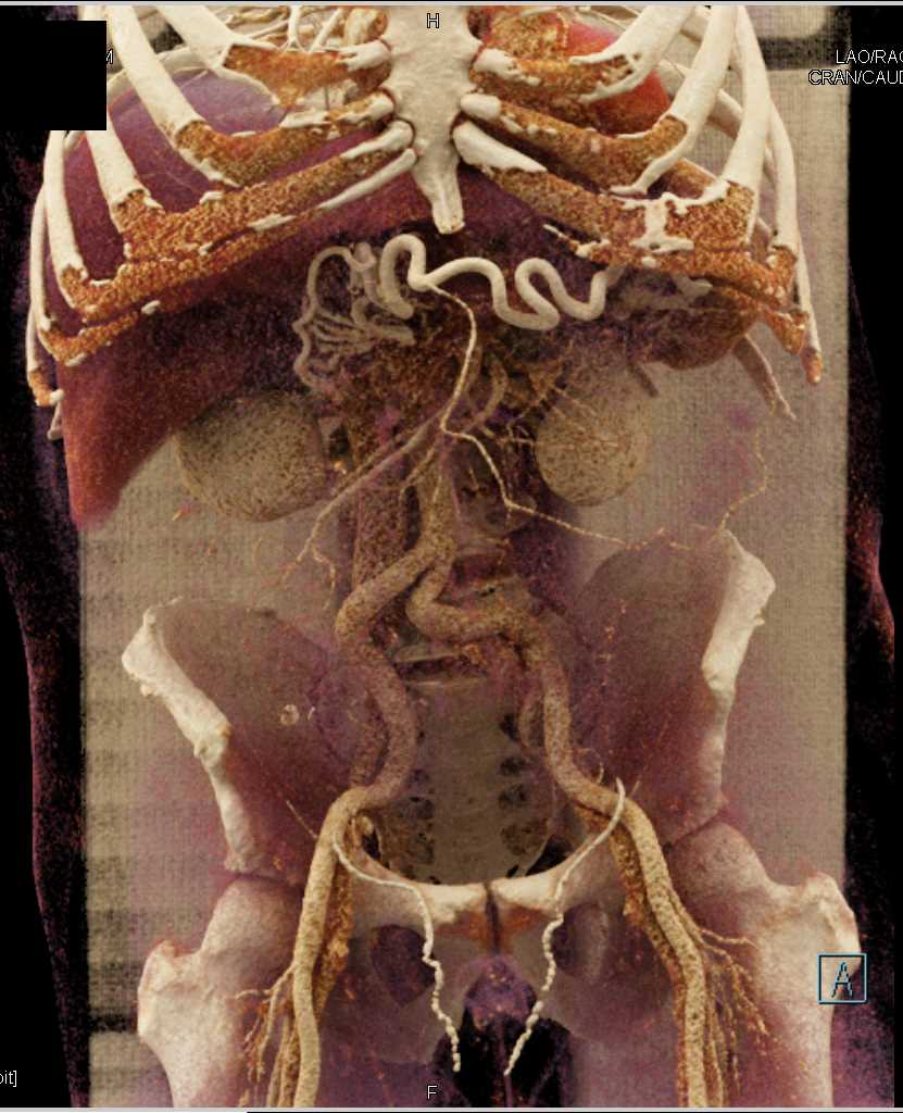 Subtle Pancreatic Cancer - CTisus CT Scan