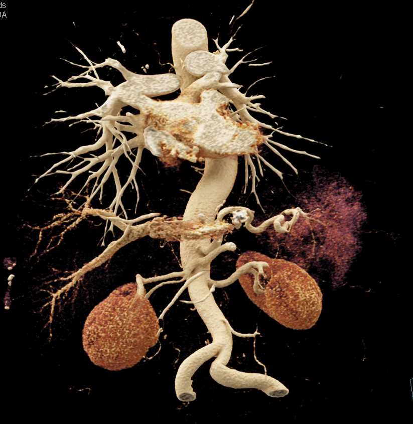 Adenocarcinoma Head of Pancreas - CTisus CT Scan