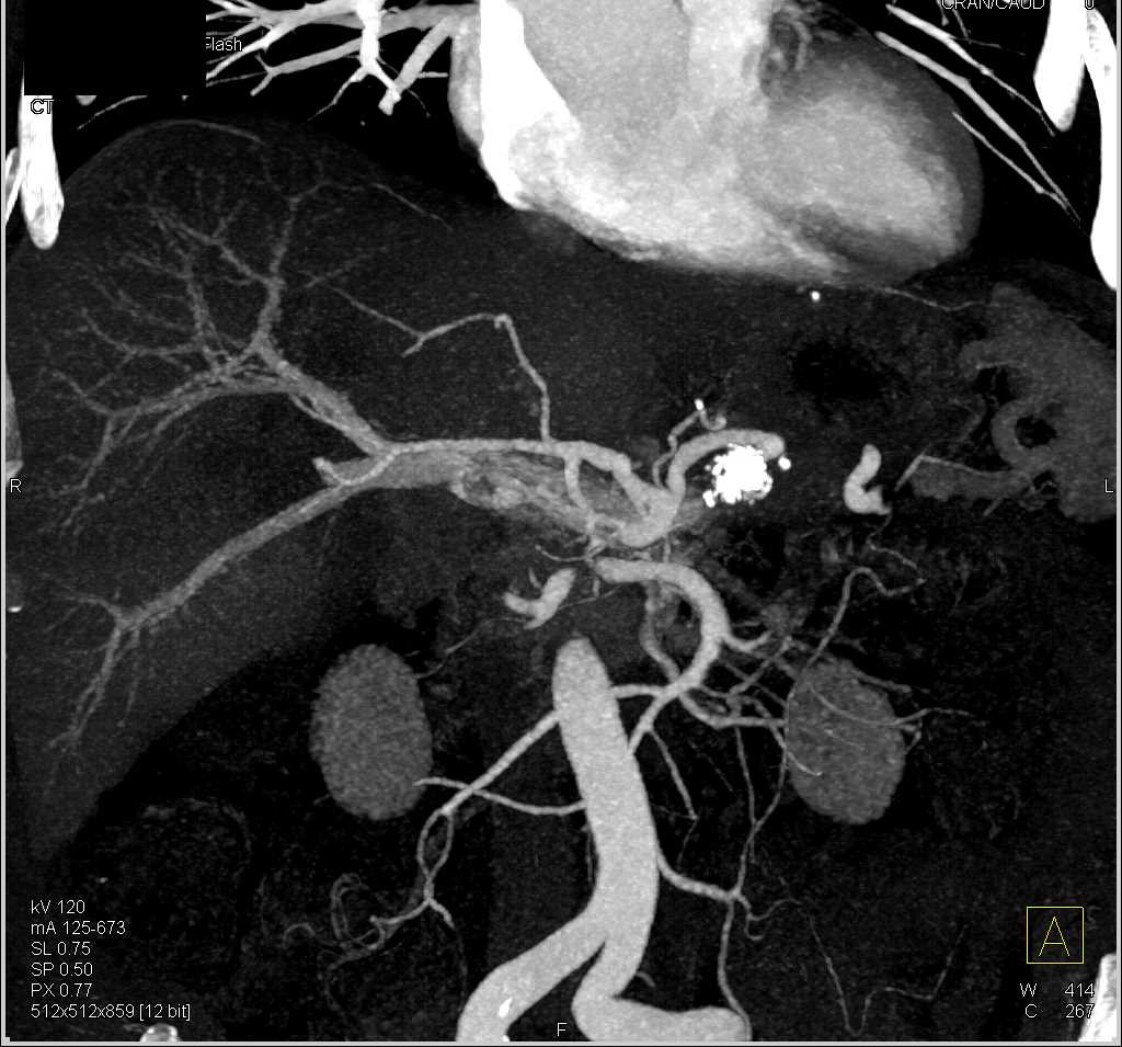 Adenocarcinoma Head of Pancreas - CTisus CT Scan