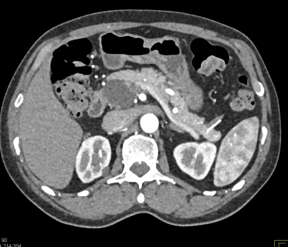 Intraductal Papillary Mucinous Neoplasm (IPMN) Head of Pancreas ...