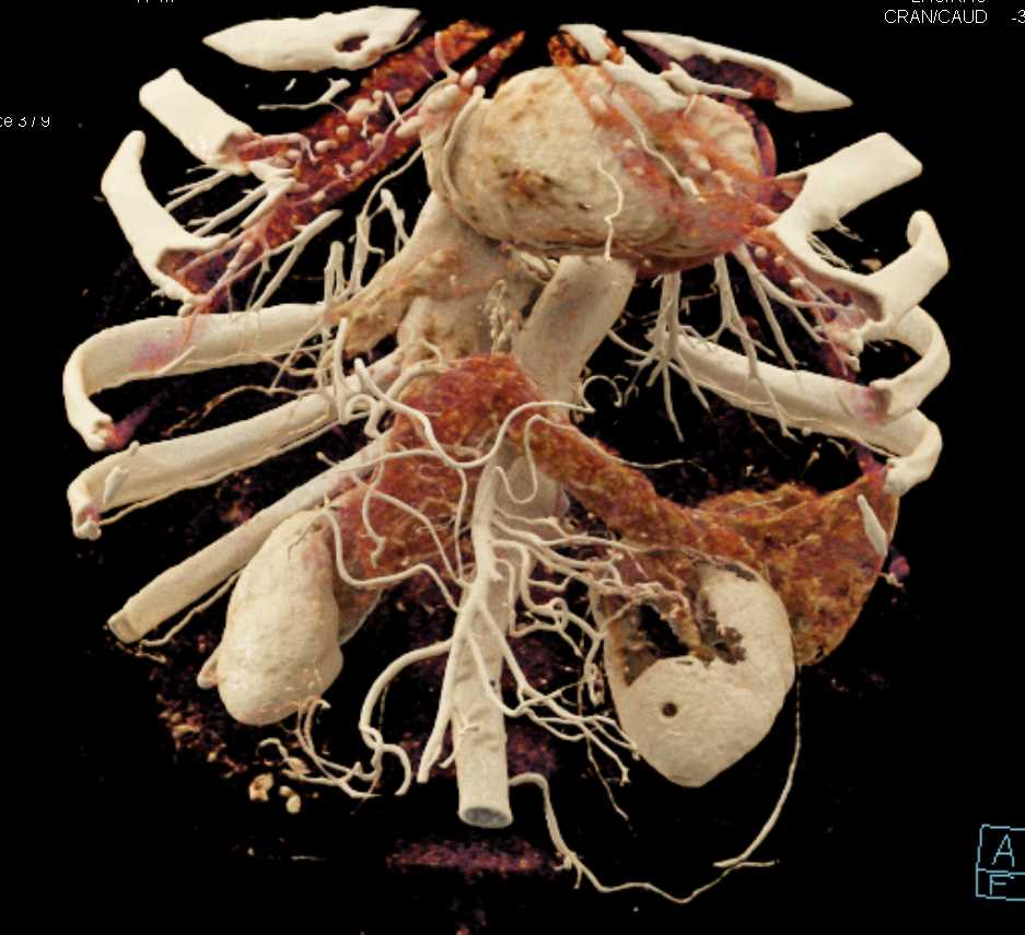 Intraductal Papillary Mucinous Neoplasm (IPMN) Head of Pancreas - CTisus CT Scan