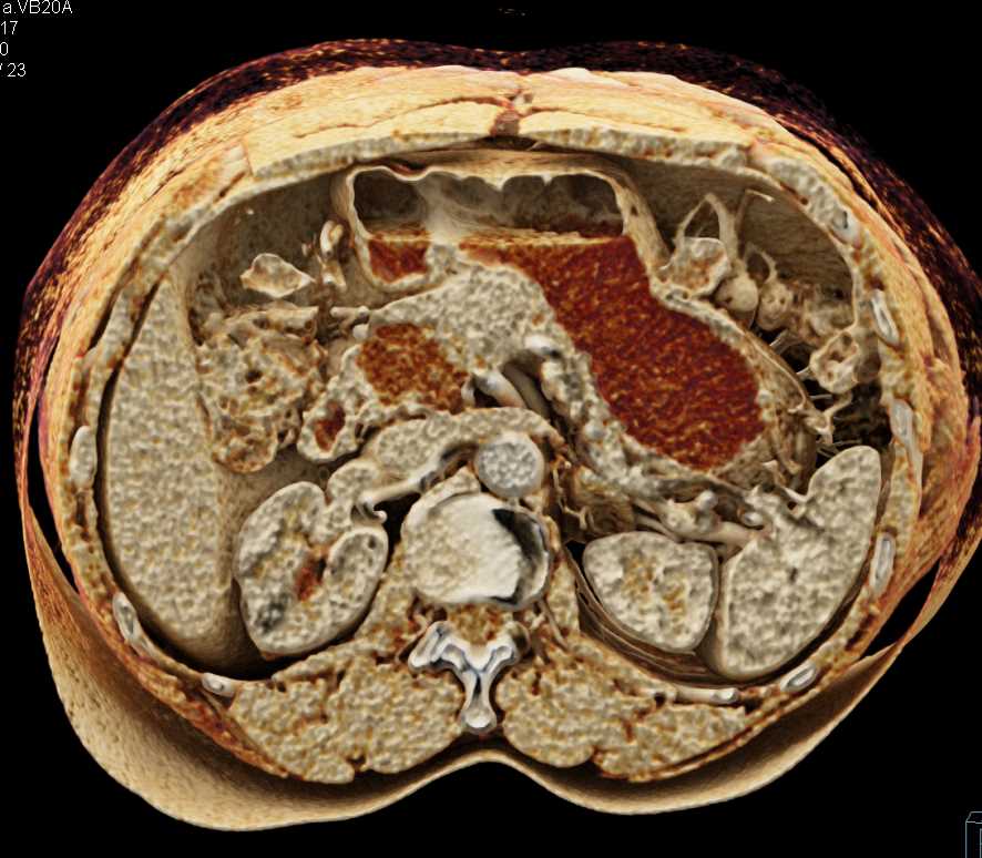 Intraductal Papillary Mucinous Neoplasm (IPMN) Head of Pancreas - CTisus CT Scan
