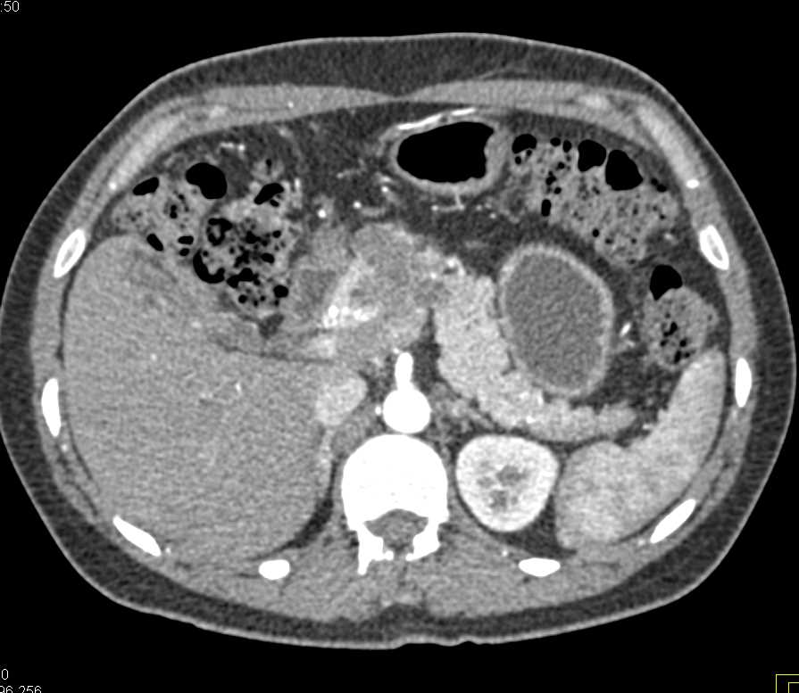 Atypical Serous Adenoma Pancreas - CTisus CT Scan