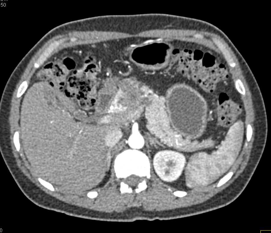 Serous Cystadenoma Pancreas - CTisus CT Scan