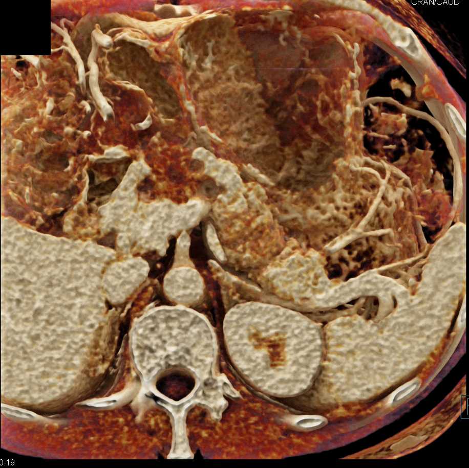 Serous Cystadenoma Pancreas - CTisus CT Scan