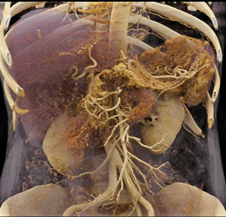 Serous Cystadenoma Pancreas - CTisus CT Scan