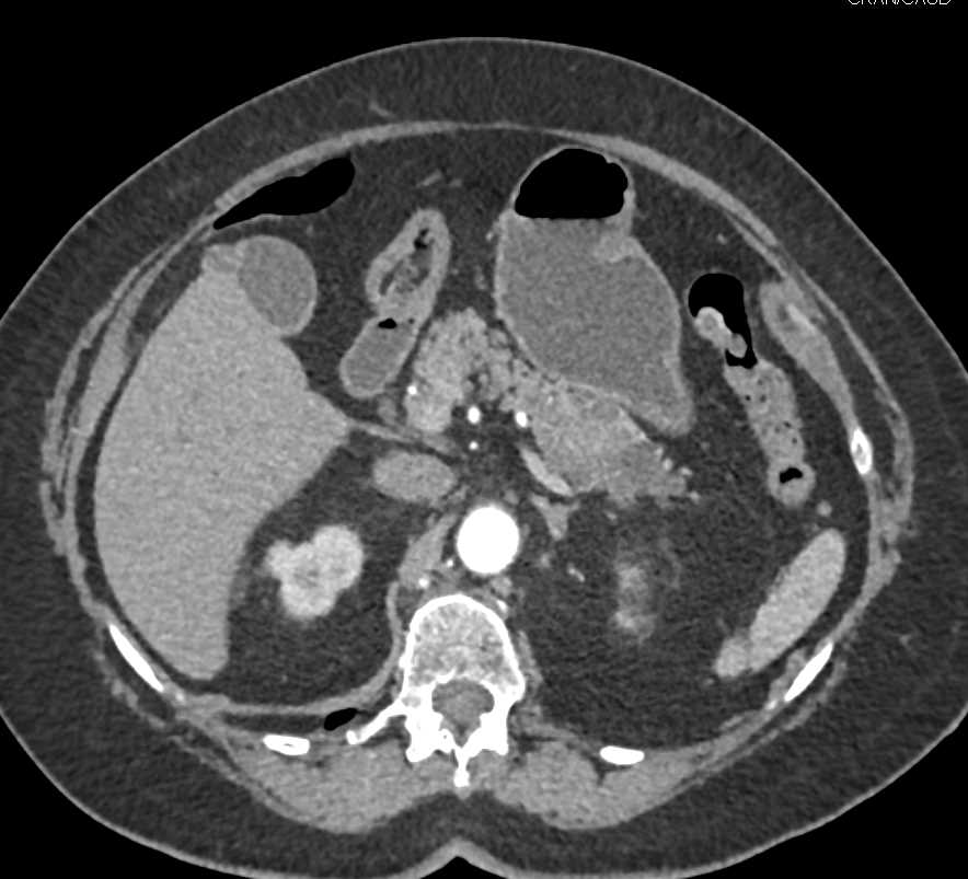 Carcinoma Tail of Pancreas - CTisus CT Scan