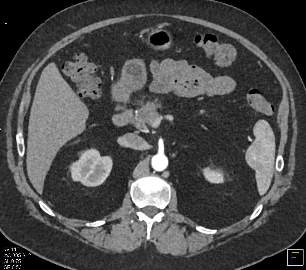 Subtle Pancreatic Cancer - CTisus CT Scan