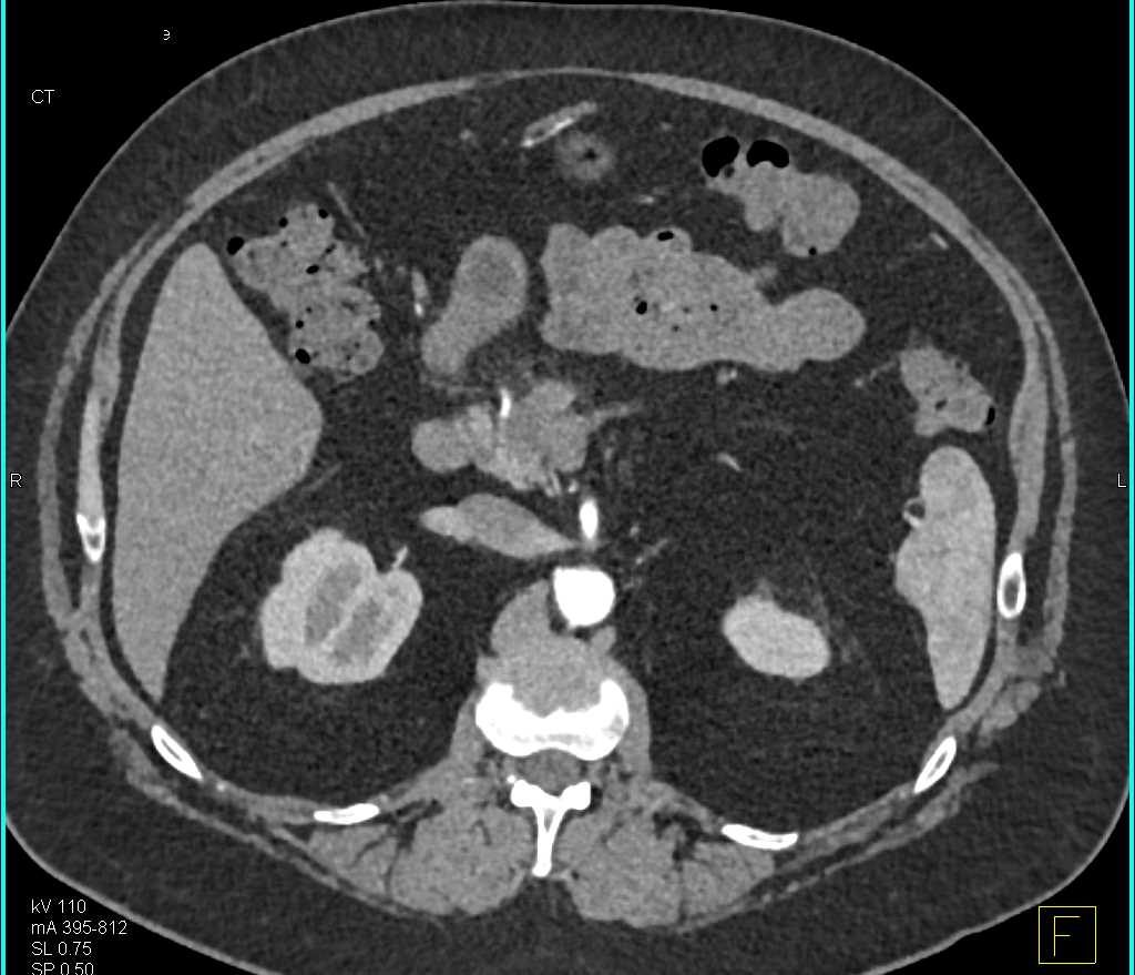 Subtle Pancreatic Cancer - CTisus CT Scan