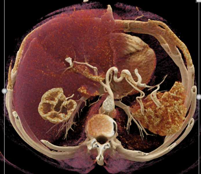 Subtle Carcinoma Head of Pancreas - CTisus CT Scan