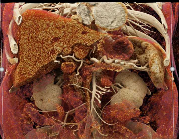 Subtle Carcinoma Head of Pancreas - CTisus CT Scan