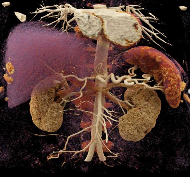 Subtle Carcinoma Head of Pancreas - CTisus CT Scan