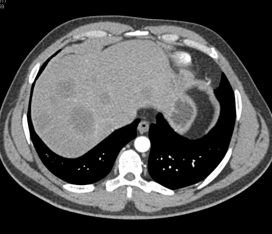 Pancreatic Cancer with Liver Metastases - CTisus CT Scan