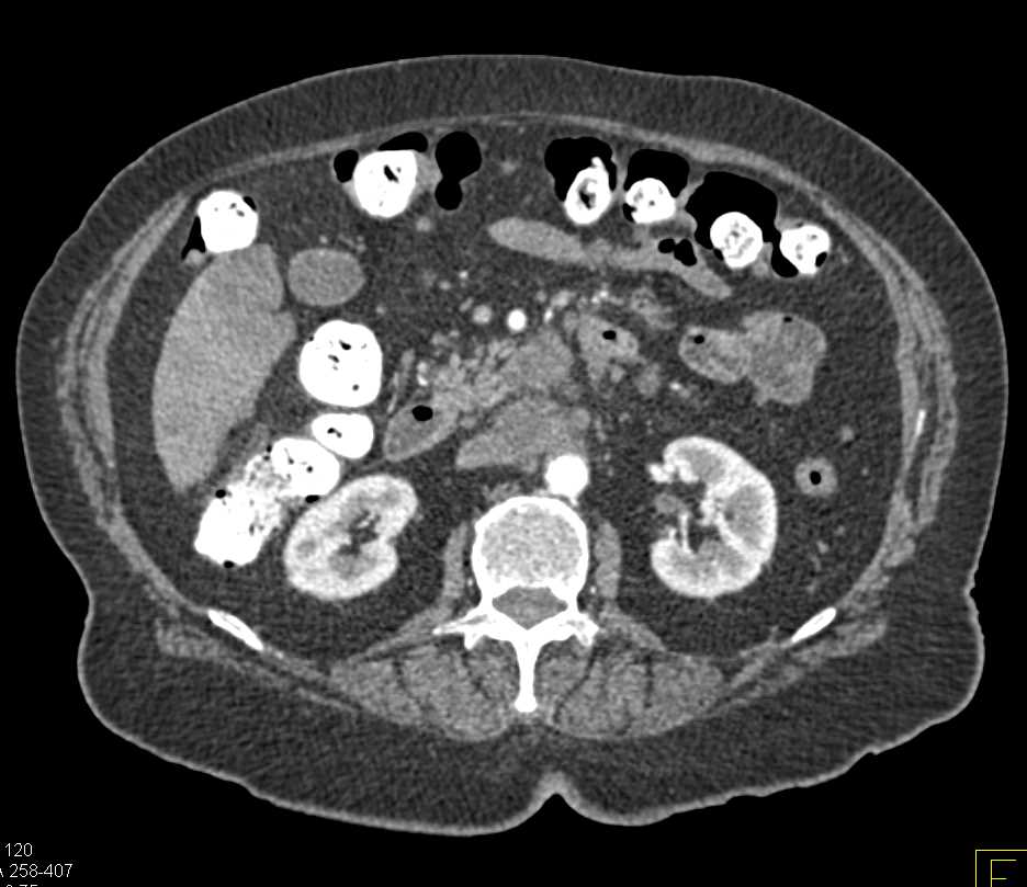 Pancreatic Cancer with Liver Metastases - CTisus CT Scan