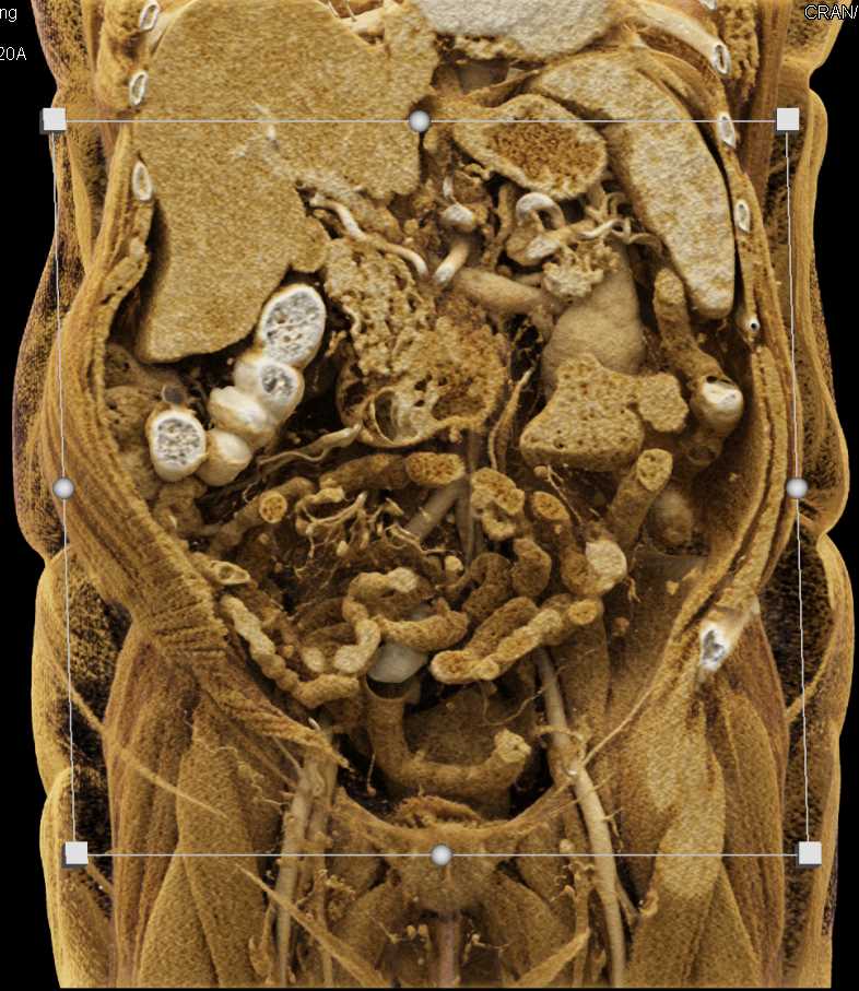 Pancreatic Cancer with Liver Metastases - CTisus CT Scan