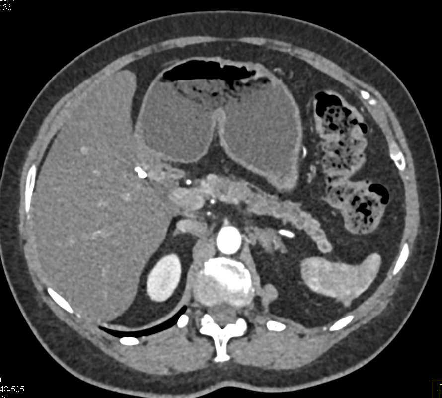 Subtle Pancreatic Cancer with Dilated Pancreatic Duct - CTisus CT Scan