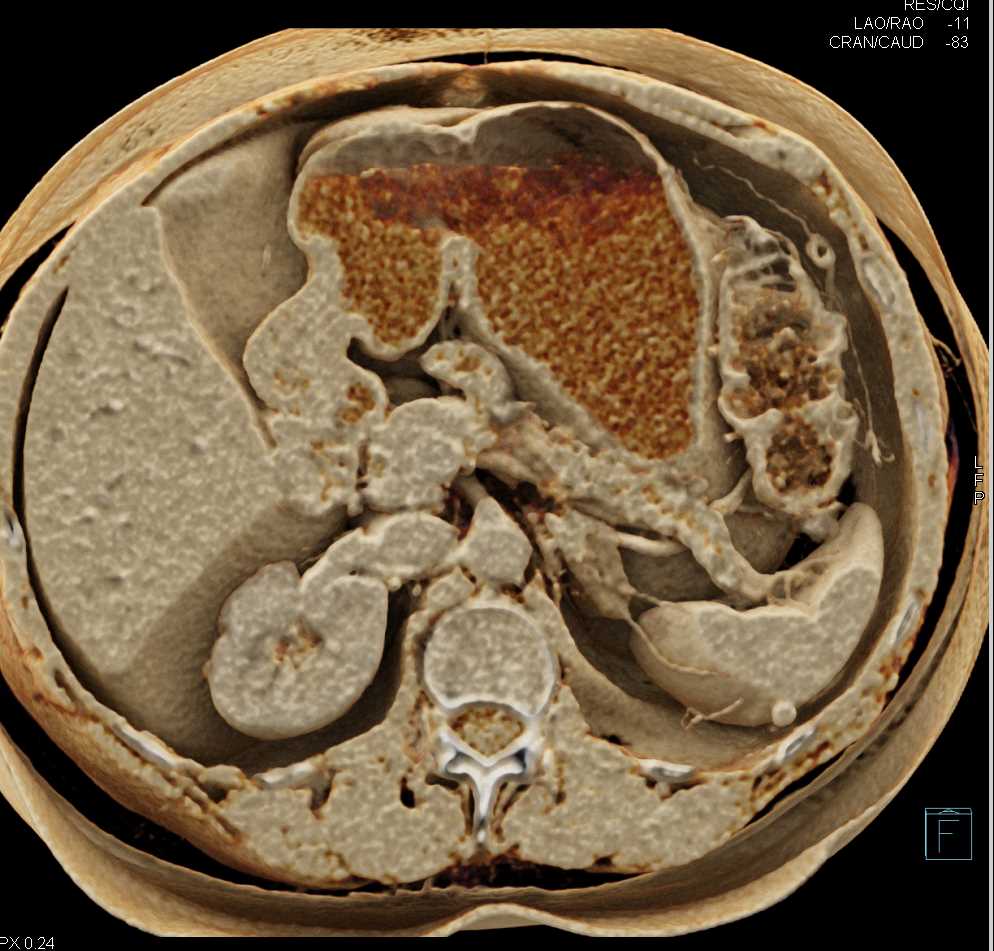 Subtle Pancreatic Cancer with Dilated Pancreatic Duct and Vascular Mapping - CTisus CT Scan