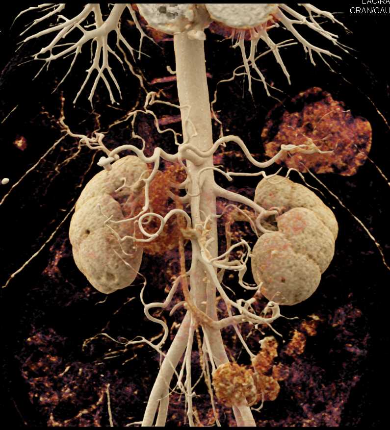 Subtle Pancreatic Cancer with Dilated Pancreatic Duct and Vascular Mapping - CTisus CT Scan