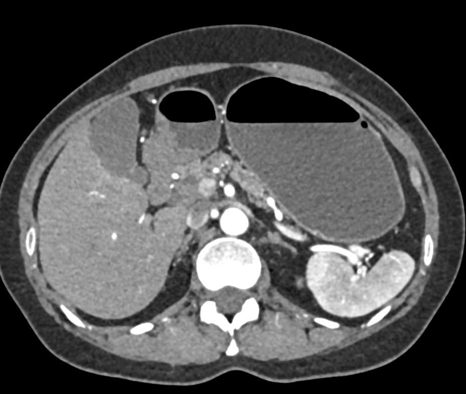 Subtle Pancreatic Cancer with Dilated Pancreatic Duct - CTisus CT Scan