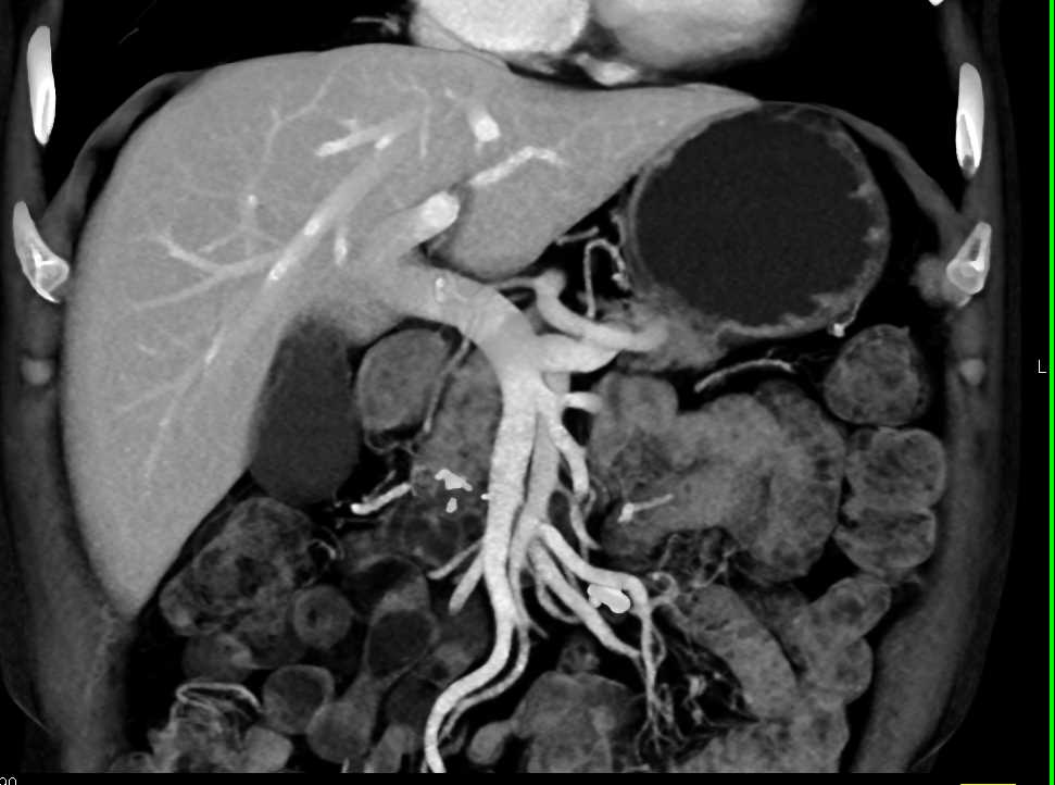 Chronic Pancreatitis - CTisus CT Scan