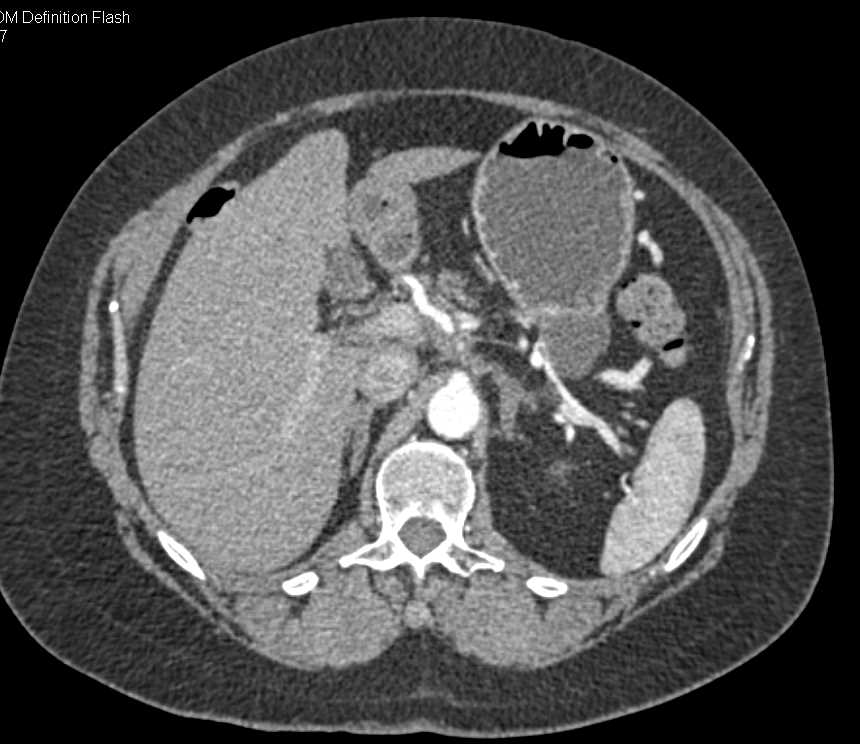 Pseudocyst Tail of Pancreas - CTisus CT Scan