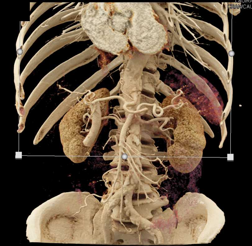 Pancreas Adenocarcinoma with Common Bile Duct (CBD) Stent - CTisus CT Scan