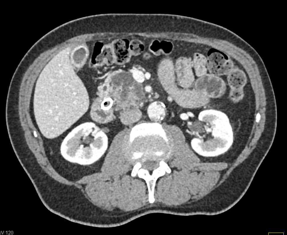 Pancreas Adenocarcinoma with Common Bile Duct (CBD) Stent - CTisus CT Scan