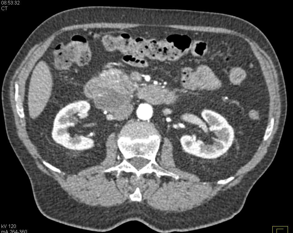 Pancreas Cancer Arises from an Intraductal Papillary Mucinous Neoplasm (IPMN) - CTisus CT Scan