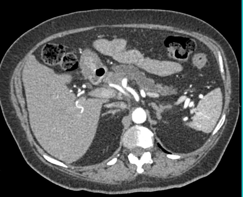 Pancreas Adenocarcinoma - CTisus CT Scan