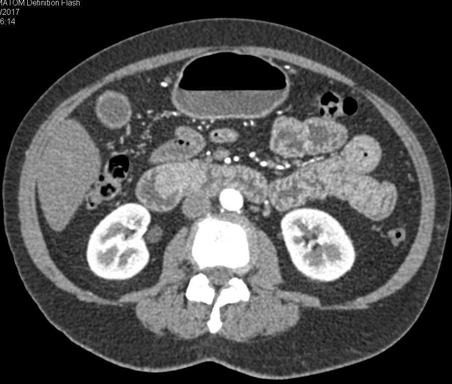 Ampullary Carcinoma and Celiac Stenosis - CTisus CT Scan