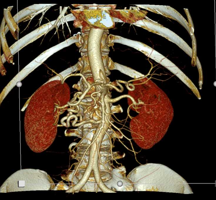 Ampullary Carcinoma and Celiac Stenosis with Cinematic Rendering - CTisus CT Scan