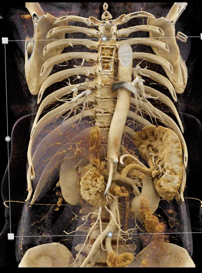 Portal Vein and Hepatic Artery Encasement by a Pancreatic Adenocarcinoma with Cinematic Rendering - CTisus CT Scan