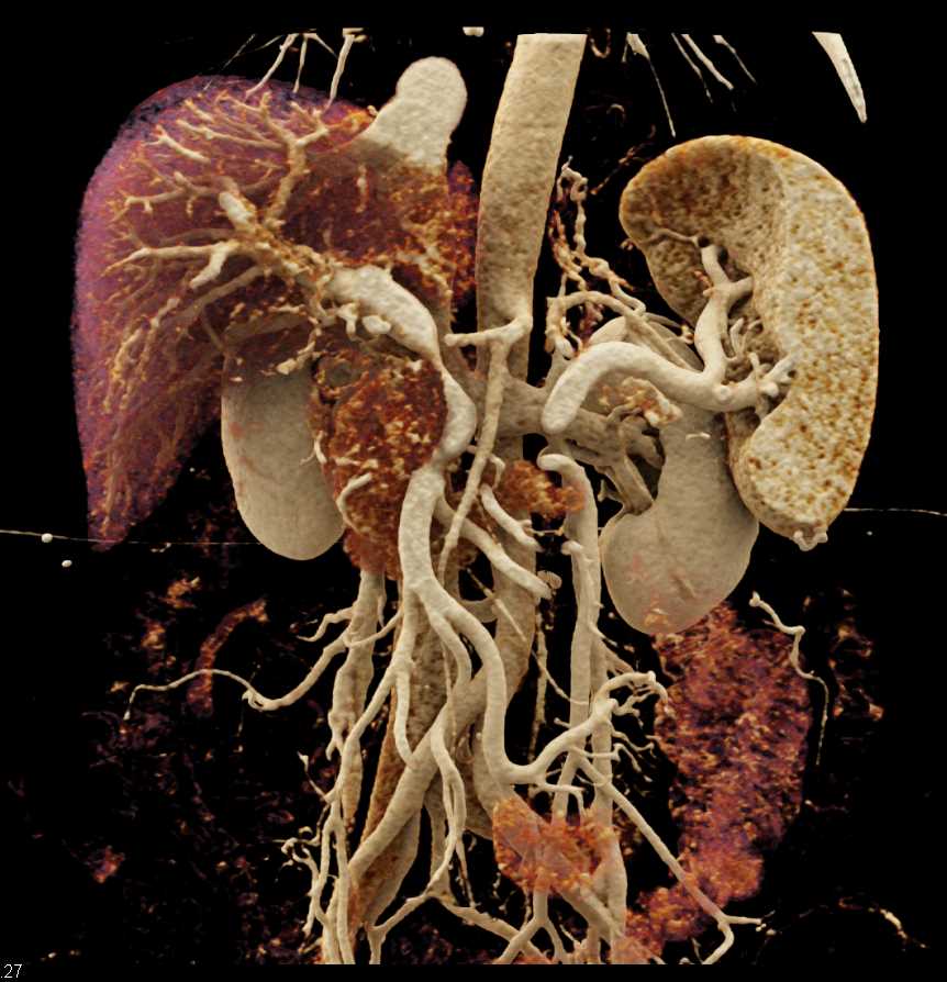 Pancreatic Cancer with Portal Vein (PV) Encasement - CTisus CT Scan
