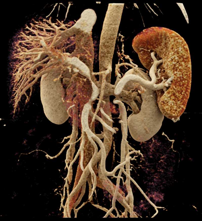 Pancreatic Cancer with Portal Vein (PV) Encasement - CTisus CT Scan