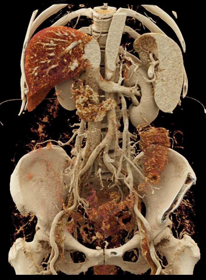 Pancreatic Cancer with Portal Vein (PV) Encasement and Impressive Collaterals - CTisus CT Scan