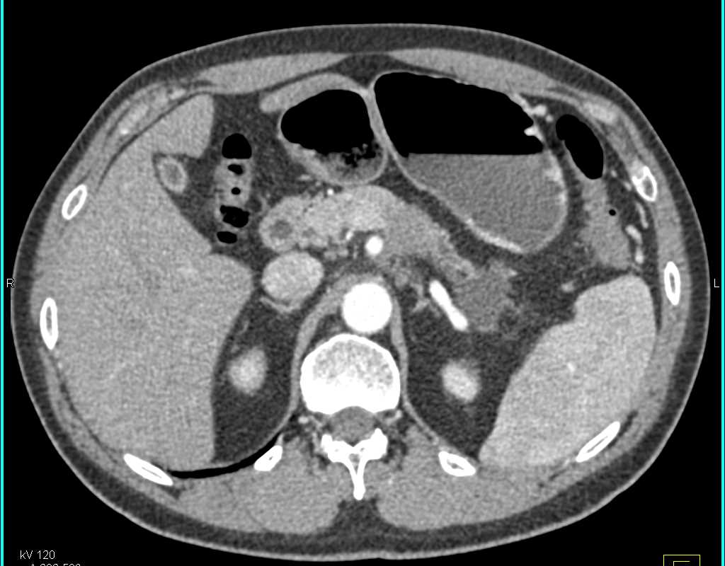 Adenocarcinoma Tail of the Pancreas - CTisus CT Scan