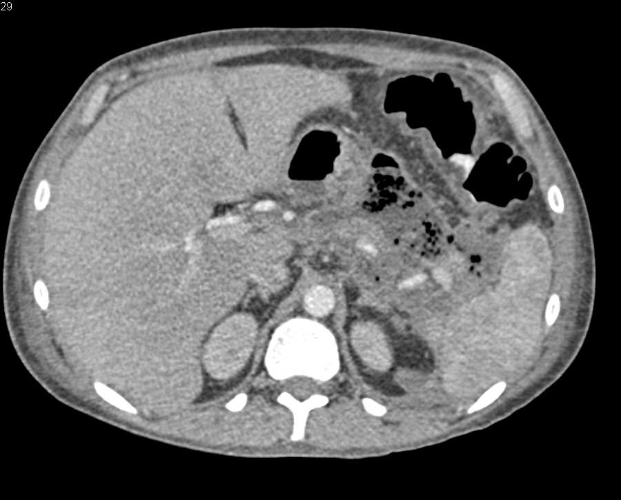 Pancreatic Necrosis Tail of Pancreas - CTisus CT Scan