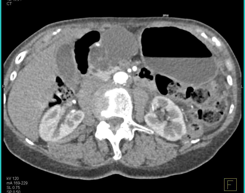 Serous Cystadenoma - CTisus CT Scan