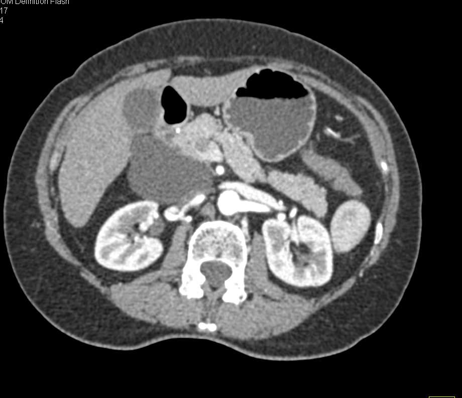 Lymphoepithelial Cyst Pancreas - CTisus CT Scan