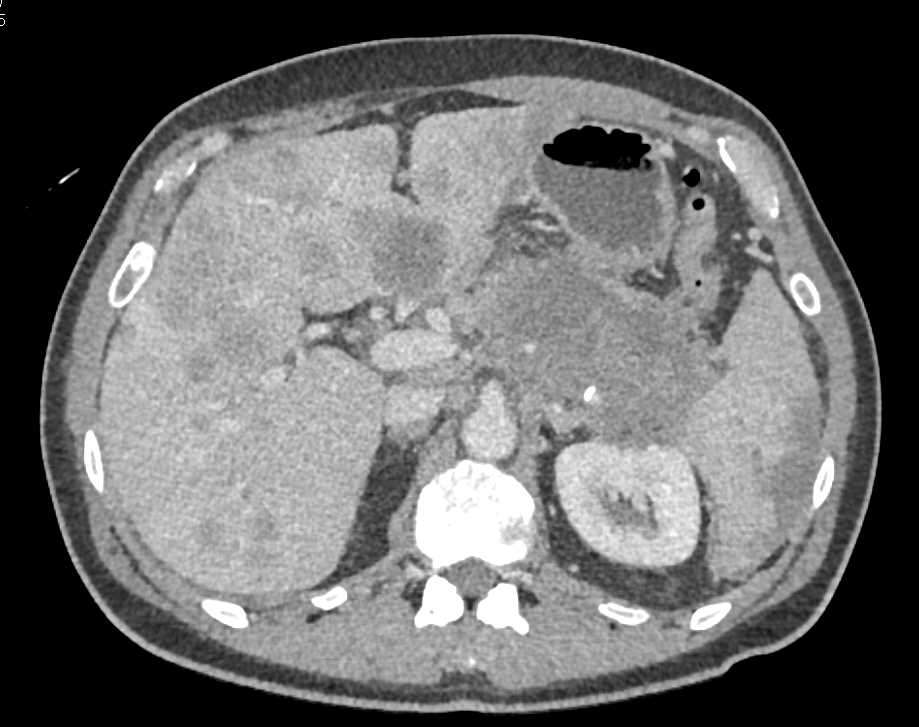 Pancreas Cancer with Liver Metastases - CTisus CT Scan