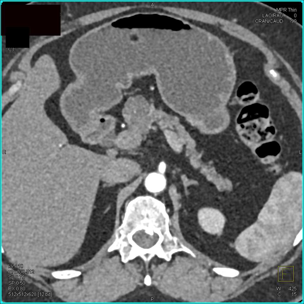 Serous Cystadenoma Head of Pancreas - CTisus CT Scan