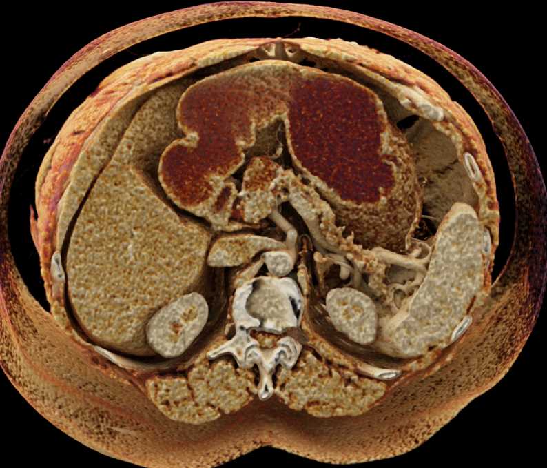 Serous Cystadenoma with Cinematic Rendering - CTisus CT Scan