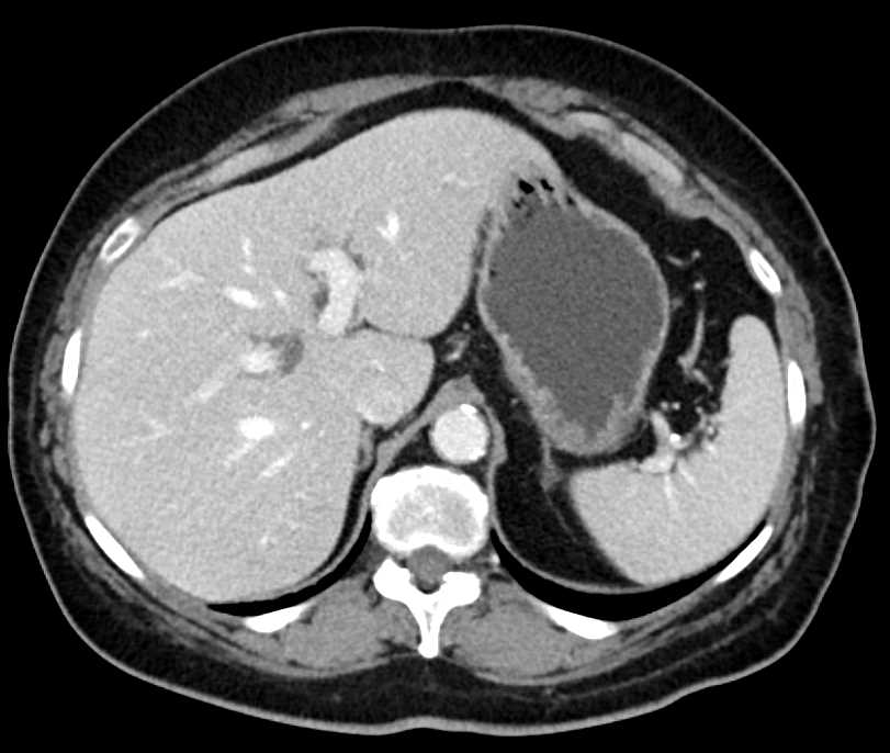 Intraductal Papillary Mucinous Neoplasm (IPMN) Pancreas - CTisus CT Scan