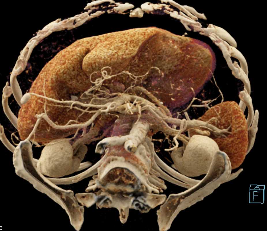 Serous Cystadenoma Tail of Pancreas with Cinematic Rendering - CTisus CT Scan