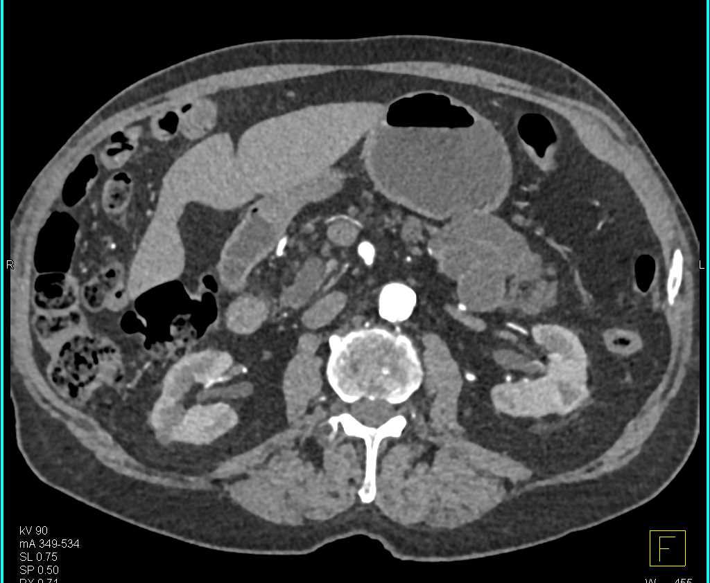 Serous Cystadenoma Tail of Pancreas - CTisus CT Scan