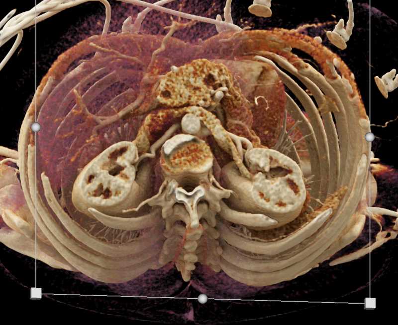Subtle Pancreas Adenocarcinoma - CTisus CT Scan